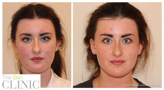 Lustre Pure Light results for acne treatment